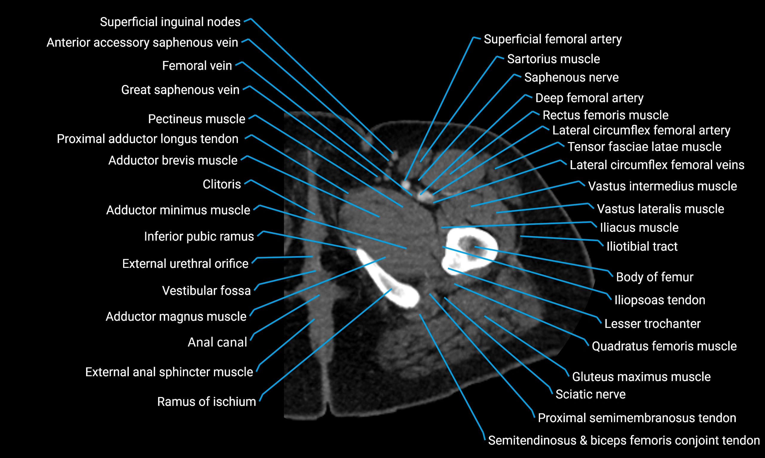 CT lower limb axial cross sectional anatomy labelled image 18 (1).webp